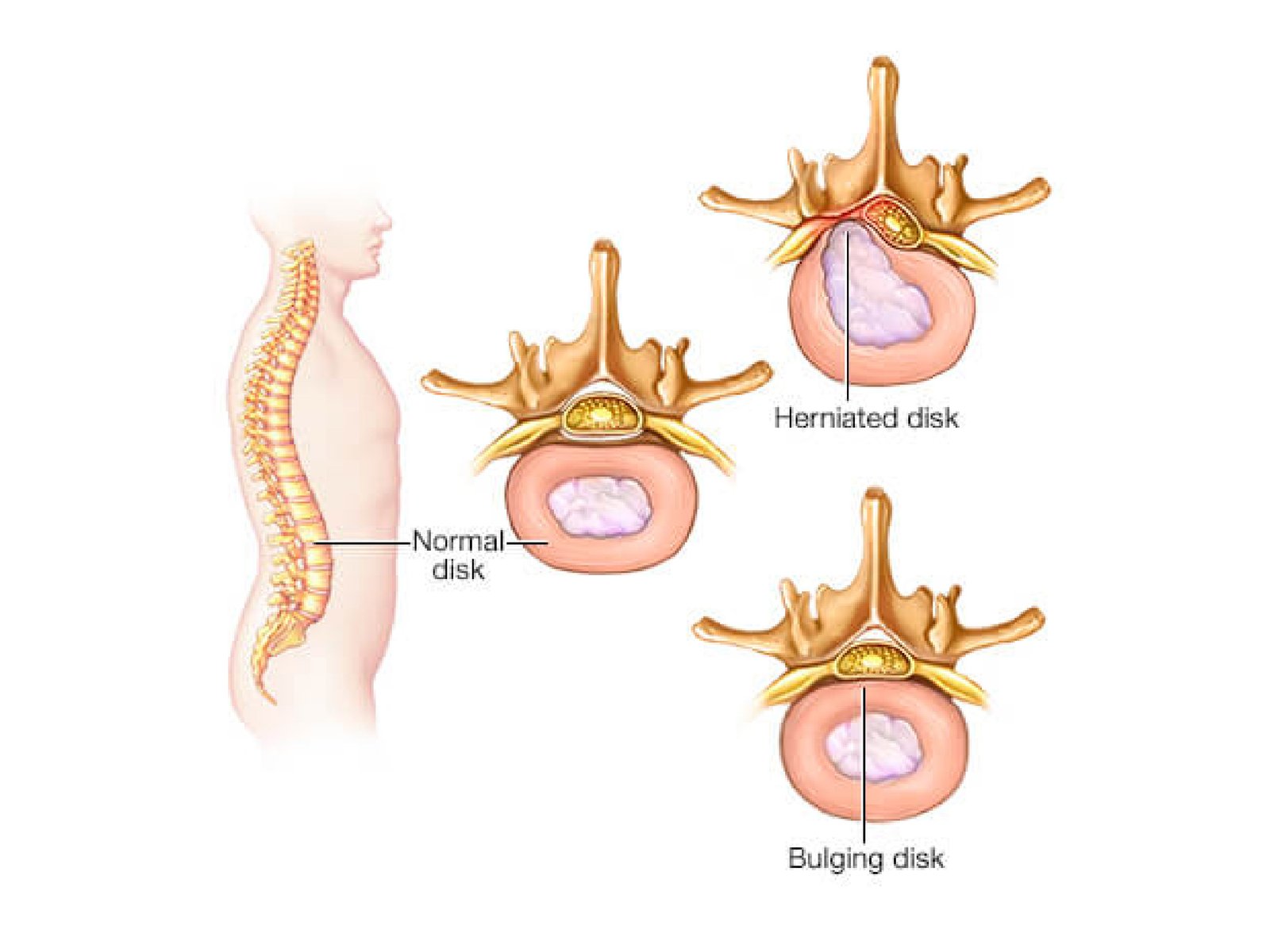 Radiculopathy